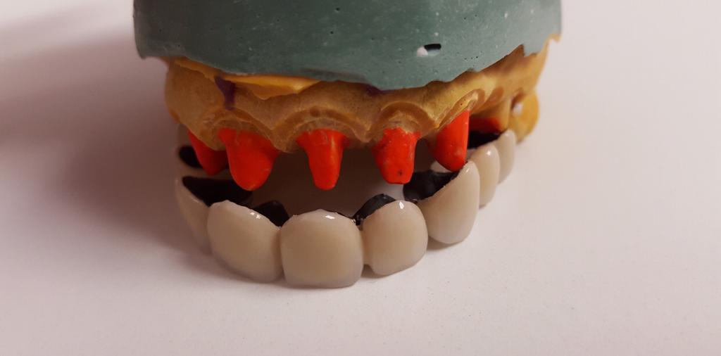 Coronas Dentales