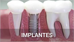 Implantes Dentales