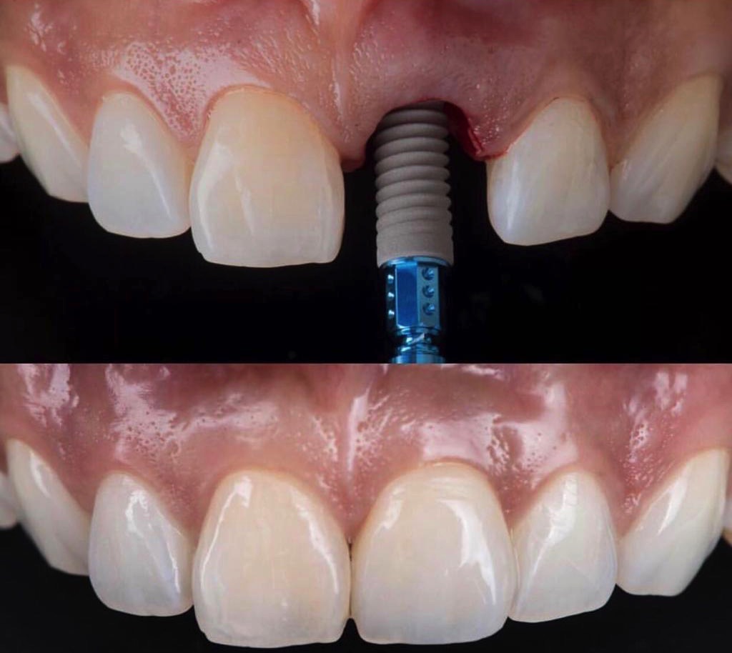 Implantes