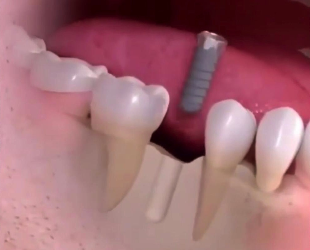 Implantes