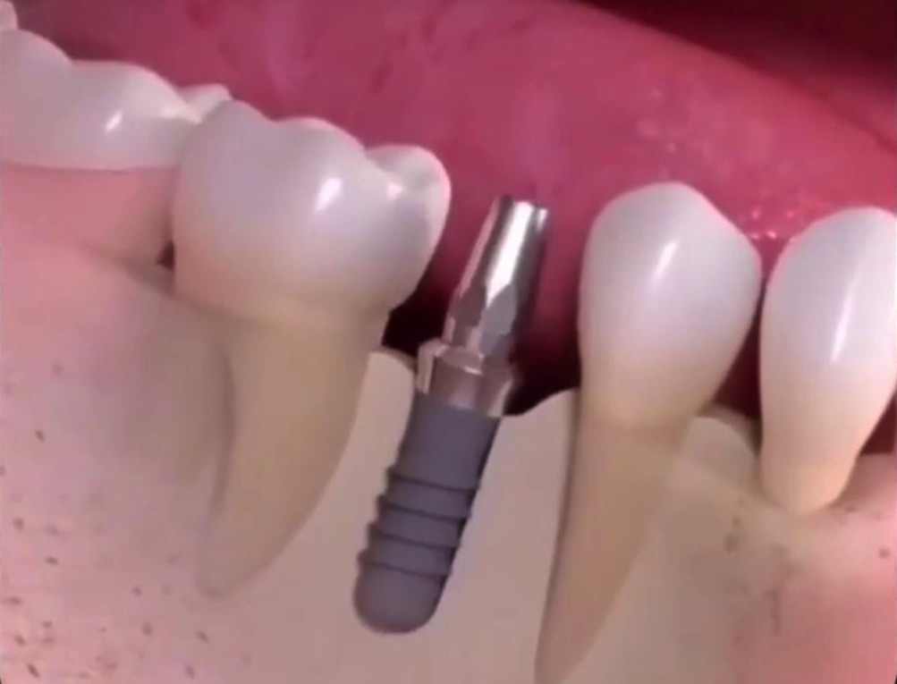 Implantes