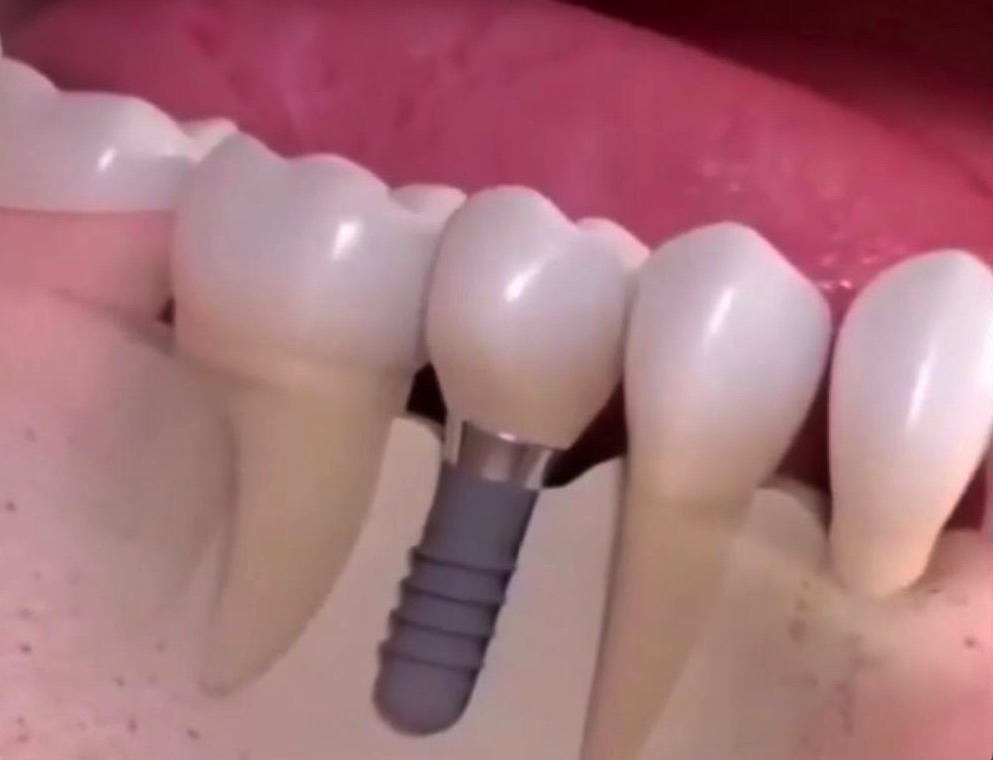 Implantes