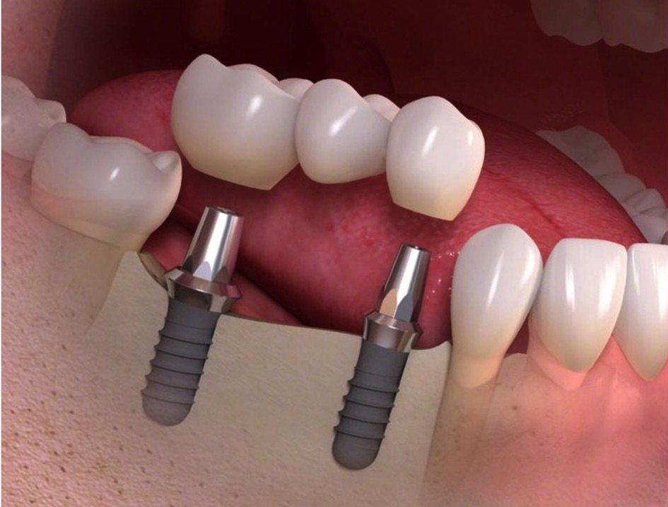Implantes