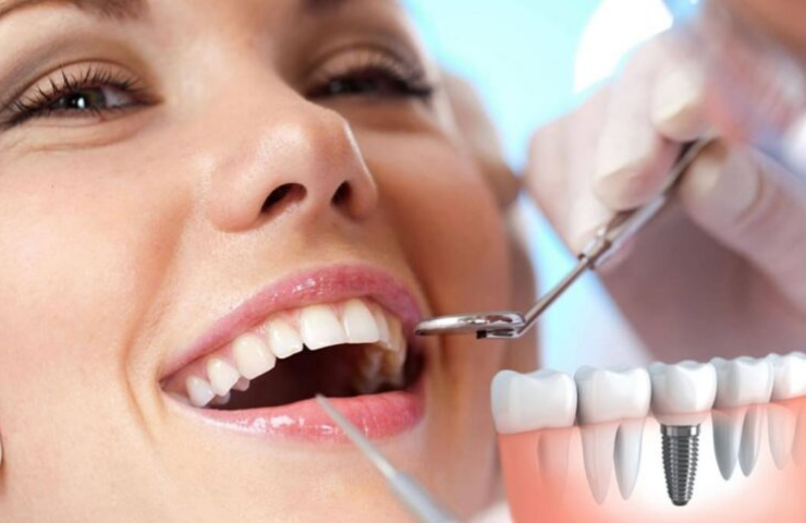 implantes dentales paredes dental