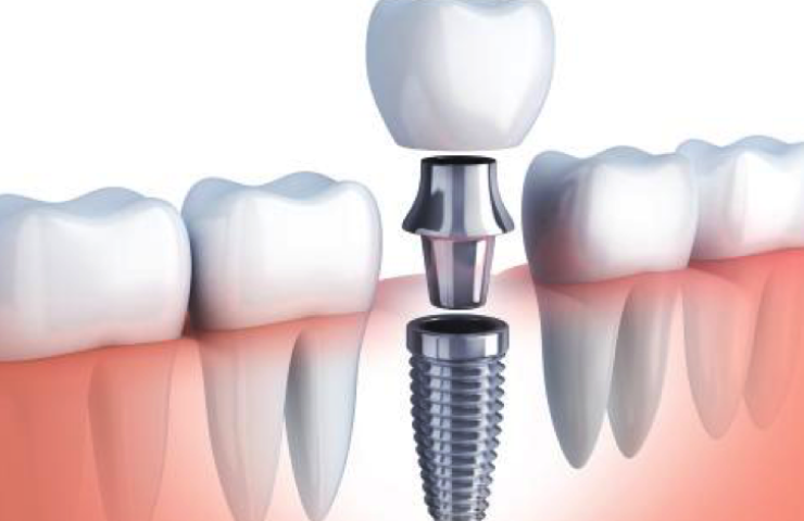 implantes dentales paredes dental