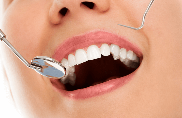 limpiezas y extracciones dentales paredes dental – 2