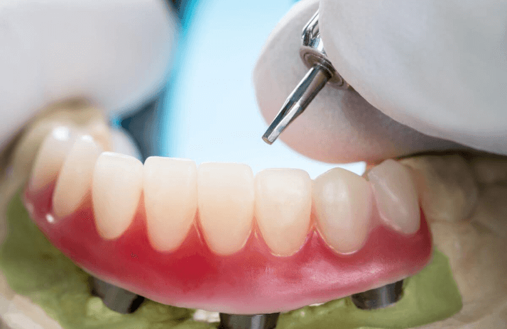 prótesis atornillada paredes dental – 1