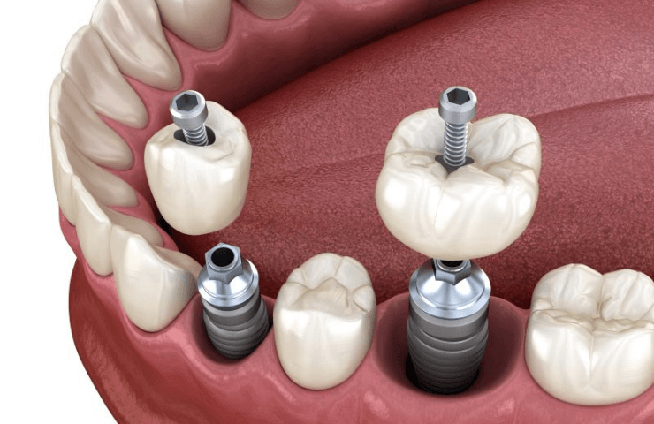prótesis atornillada paredes dental