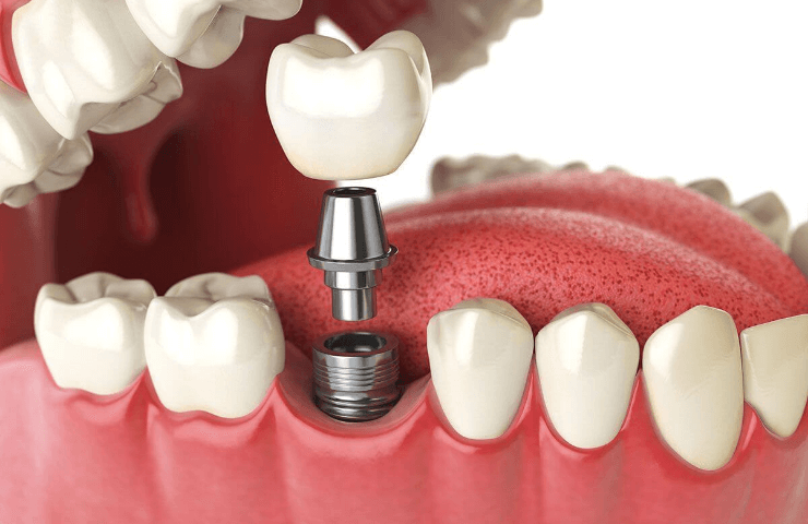 prótesis atornillada paredes dental