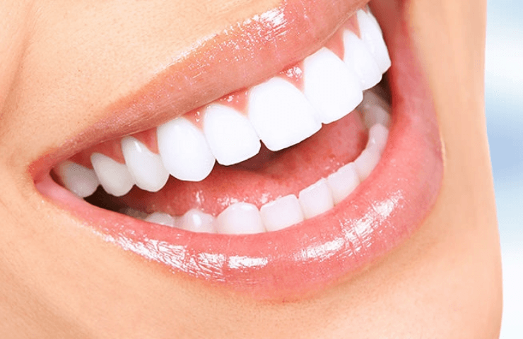 carillas de resina y porcelana paredes dental bahia blanca