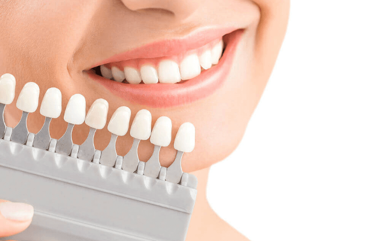 carillas de resina y porcelana paredes dental – bahia blanca 2
