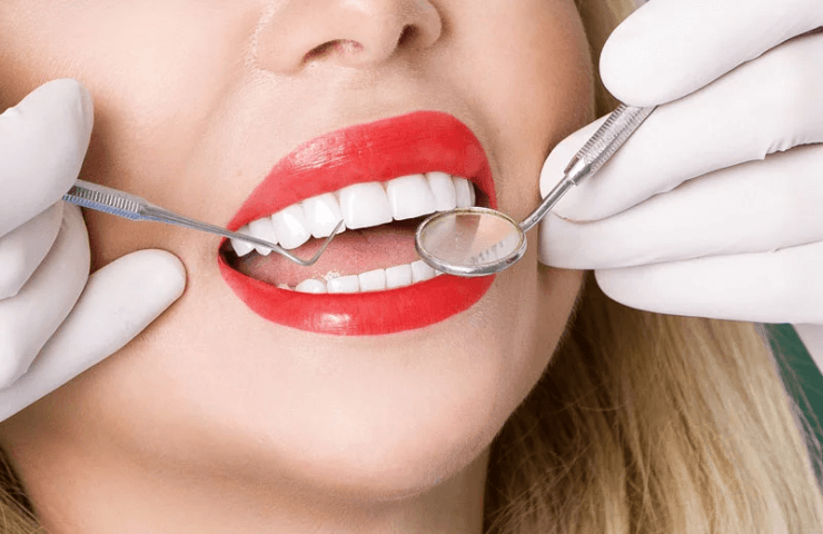 carillas de resina y porcelana paredes dental – bahia blanca 3