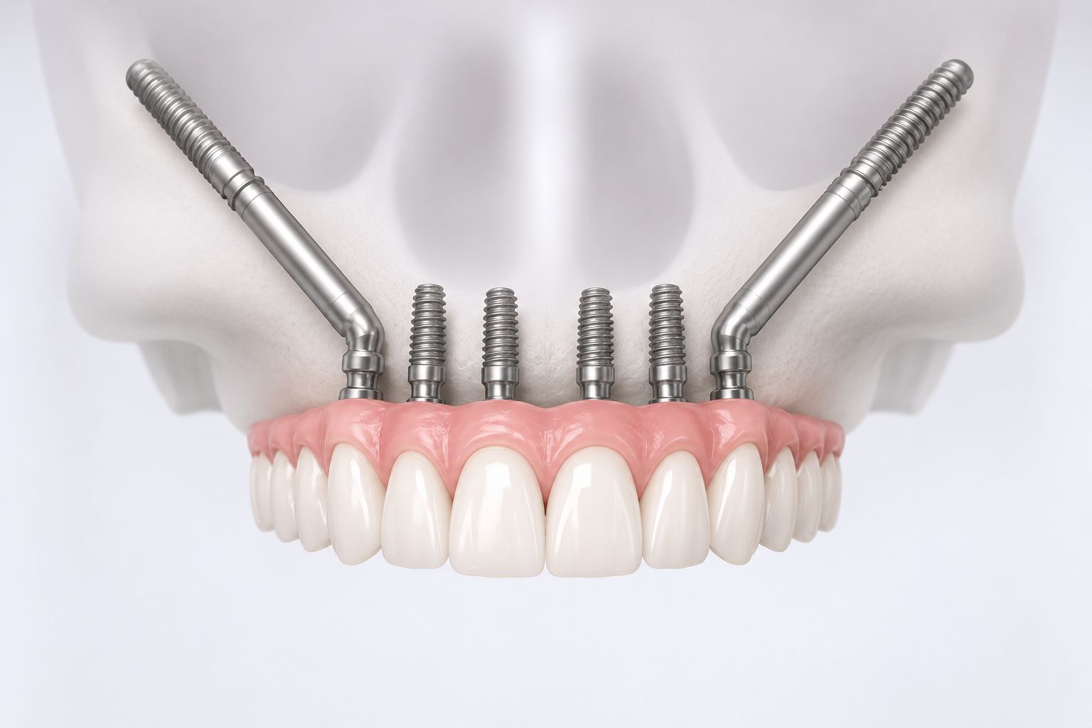implantes-cigomaticos